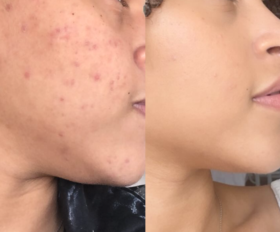 Resultado L&iacute;dia &mdash; antes e depois Sabonete Rose Almeida